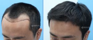 Cấy tóc FUE 1989 nang, nam 37 tuổi, kết quả sau 8 tháng - case 4