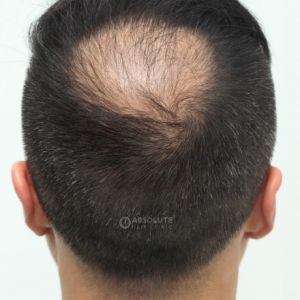 Cấy tóc FUE 1500 nang trị hói đỉnh đầu - case 47