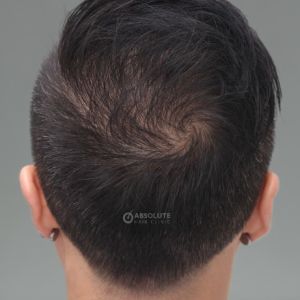 Cấy tóc FUE 1500 nang trị hói đỉnh đầu - case 47