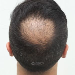 Cấy tóc FUE 1500 nang trị hói đỉnh đầu - case 47