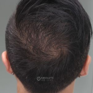 Cấy tóc FUE 1500 nang trị hói đỉnh đầu - case 47