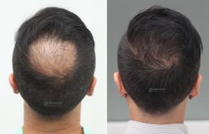 Cấy tóc FUE 1500 nang trị hói đỉnh đầu - case 47