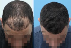 Cấy tóc FUE 1786 nang, khách nam 44 tuổi - case 48