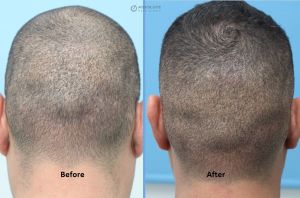 Cấy tóc FUE 1786 nang, khách nam 44 tuổi - case 48