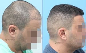 Cấy tóc FUE 1786 nang, khách nam 44 tuổi - case 48