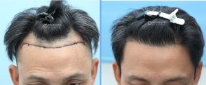 Cấy tóc FUE 1537 nang hạ thấp đường chân tóc - case 49