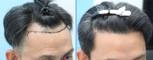 Cấy tóc FUE 1537 nang hạ thấp đường chân tóc - case 49