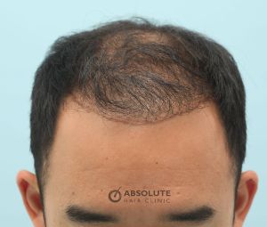 Cấy tóc FUE 3060 nang, nam 31 tuổi, kết quả sau 17 tháng - case 5