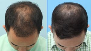 Cấy tóc FUE 3060 nang, nam 31 tuổi, kết quả sau 17 tháng - case 5