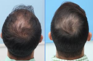 Cấy tóc FUE 3060 nang, nam 31 tuổi, kết quả sau 17 tháng - case 5