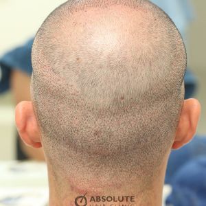 Cấy tóc FUE 3060 nang, nam 31 tuổi, kết quả sau 17 tháng - case 5