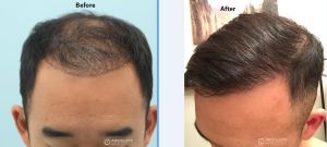 Cấy tóc FUE 3060 nang, nam 31 tuổi, kết quả sau 17 tháng - case 5