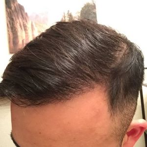 Cấy tóc FUE 3060 nang, nam 31 tuổi, kết quả sau 17 tháng - case 5