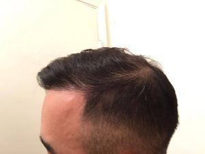 Cấy tóc FUE 3060 nang, nam 31 tuổi, kết quả sau 17 tháng - case 5