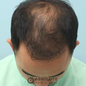 Cấy tóc FUE 3060 nang, nam 31 tuổi, kết quả sau 17 tháng - case 5