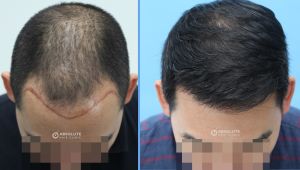 Cấy tóc FUE 2890 nang, kết quả sau 13 tháng - case 51