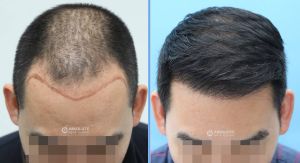 Cấy tóc FUE 2890 nang, kết quả sau 13 tháng - case 51