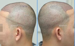 Cấy tóc FUE 2890 nang, kết quả sau 13 tháng - case 51