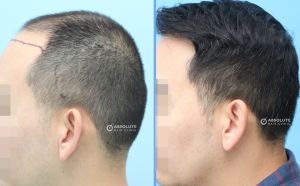 Cấy tóc FUE 2890 nang, kết quả sau 13 tháng - case 51