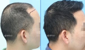 Cấy tóc FUE 2890 nang, kết quả sau 13 tháng - case 51
