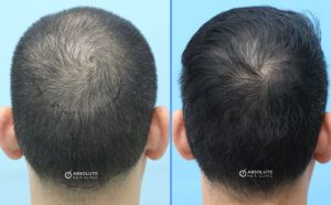 Cấy tóc FUE 2890 nang, kết quả sau 13 tháng - case 51