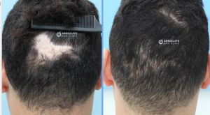 Cấy tóc trên sẹo, 600 nang kỹ thuật FUE - case 53