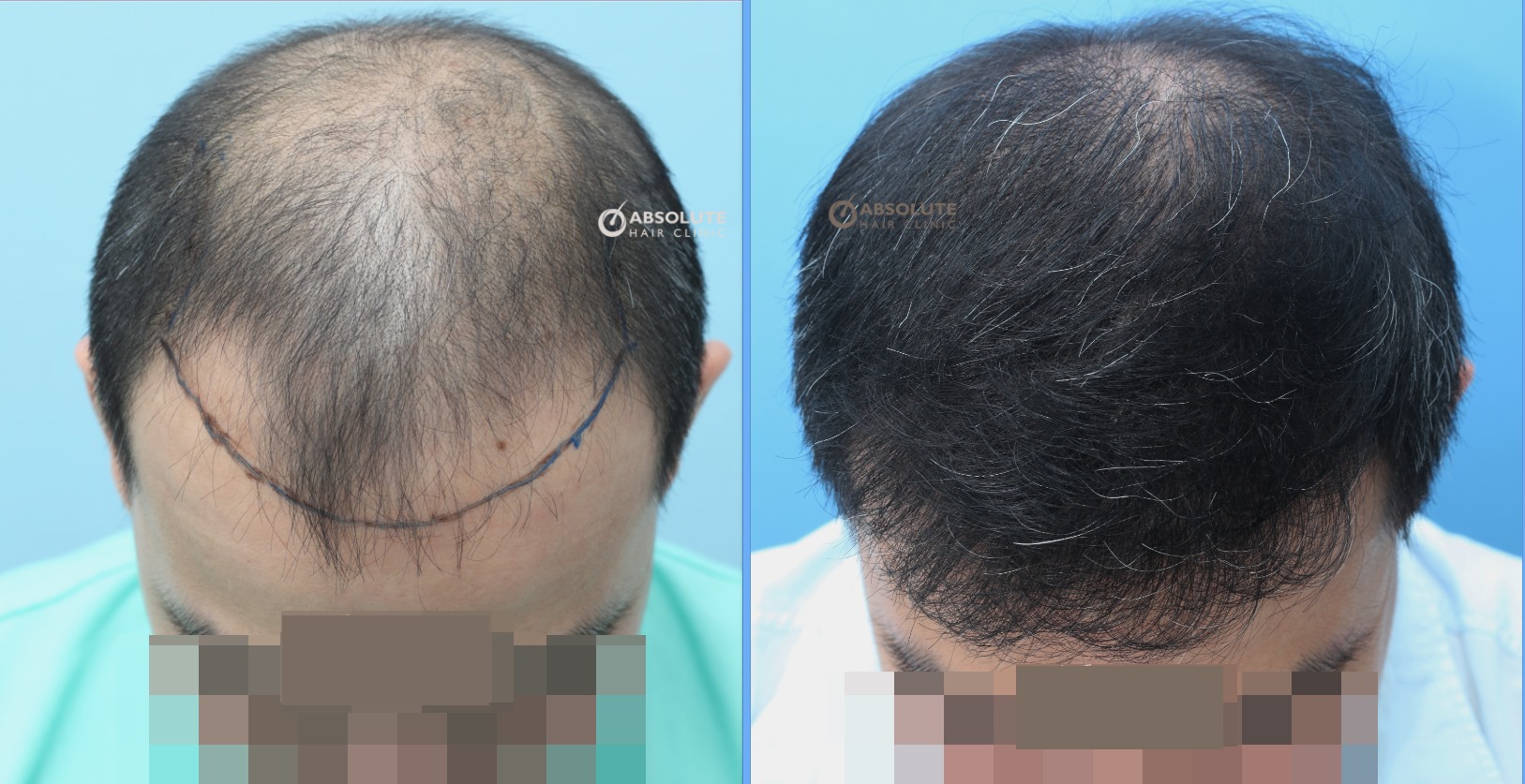 Cấy 3412 nang tóc, kỹ thuật FUE, kết quả sau 10 tháng - case 54