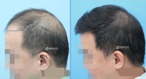 Cấy 3412 nang tóc, kỹ thuật FUE, kết quả sau 10 tháng - case 54