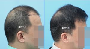 Cấy 3412 nang tóc, kỹ thuật FUE, kết quả sau 10 tháng - case 54