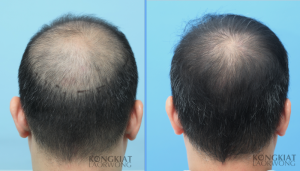 Cấy 3412 nang tóc, kỹ thuật FUE, kết quả sau 10 tháng - case 54
