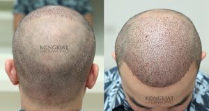 Cấy 3412 nang tóc, kỹ thuật FUE, kết quả sau 10 tháng - case 54