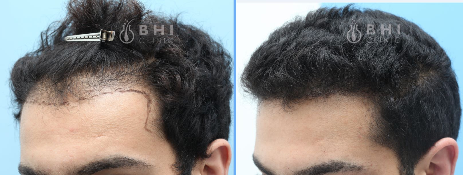 Cấy tóc FUE 1790 nang, kết quả 6 tháng sau cấy - case 57