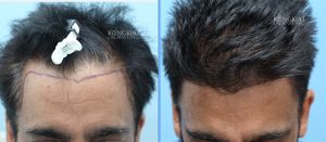 Cấy tóc FUE 1709 nang, hạ thấp đường chân tóc - case 59