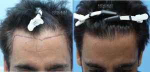 Cấy tóc FUE 1709 nang, hạ thấp đường chân tóc - case 59