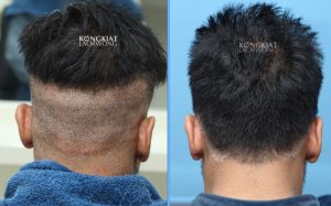 Cấy tóc FUE 1709 nang, hạ thấp đường chân tóc - case 59