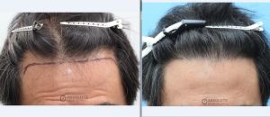 Cấy tóc FUE 924 nang tóc hạ thấp đường chân tóc sau 11 tháng, nam 56 tuổi - case 6