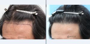 Cấy tóc FUE 924 nang tóc hạ thấp đường chân tóc sau 11 tháng, nam 56 tuổi - case 6