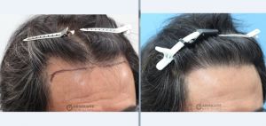 Cấy tóc FUE 924 nang tóc hạ thấp đường chân tóc sau 11 tháng, nam 56 tuổi - case 6