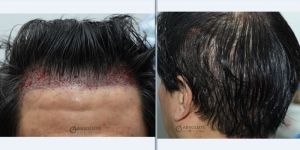 Cấy tóc FUE 924 nang tóc hạ thấp đường chân tóc sau 11 tháng, nam 56 tuổi - case 6