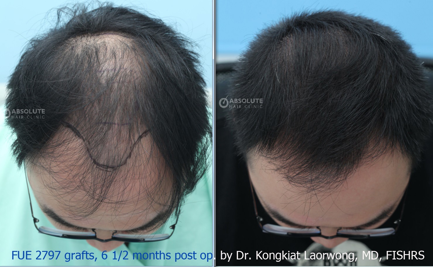 Cấy tóc FUE 2797 nang, nam 27 tuổi, kết quả sau 6.5 tháng - case 7