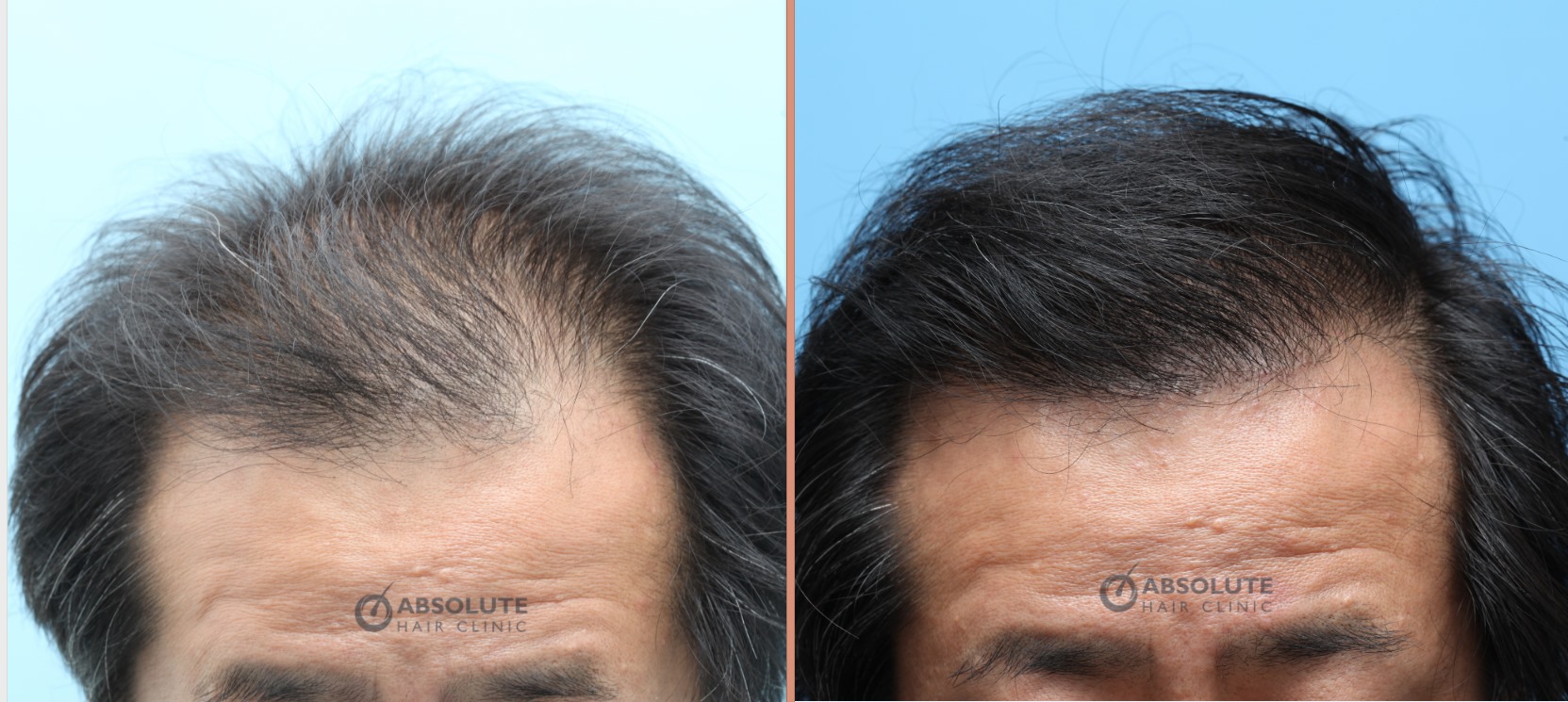 Cấy tóc FUE 3000 nang, kết quả sau 1 năm - case 71