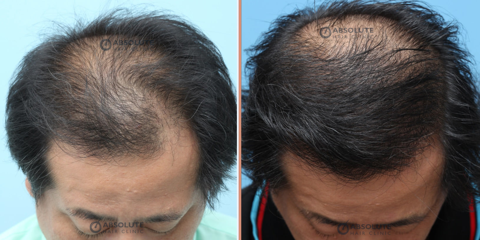 Cấy tóc FUE 3000 nang, kết quả sau 1 năm - case 71