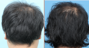 Cấy tóc FUE 3000 nang, kết quả sau 1 năm - case 71