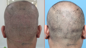 Cấy tóc FUE 3000 nang, kết quả sau 1 năm - case 71