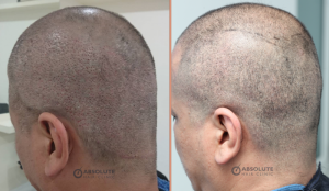 Cấy tóc FUE 3000 nang, kết quả sau 1 năm - case 71