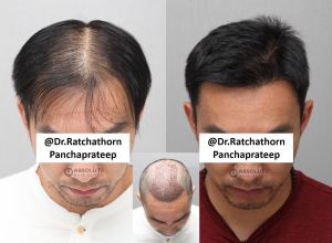 Cấy 2700 nang tóc khắc phục tóc thưa mỏng, kết quả sau 5 tháng - case 72