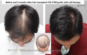 Cấy 2700 nang tóc khắc phục tóc thưa mỏng, kết quả sau 5 tháng - case 72