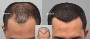 Cấy tóc FUE 3400 nang điều hói đỉnh đầu - case 78