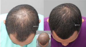 Cấy tóc FUE 3400 nang điều hói đỉnh đầu - case 78