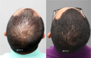 Cấy tóc FUE 3400 nang điều hói đỉnh đầu - case 78